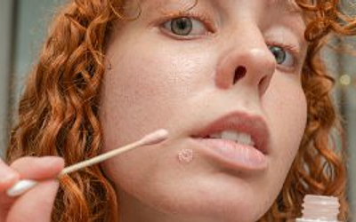 Як позбутися прищів: дієві засоби та поради для чистої шкіри