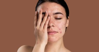 Догляд за проблемною шкірою: як очистити обличчя і покращити стан шкіри