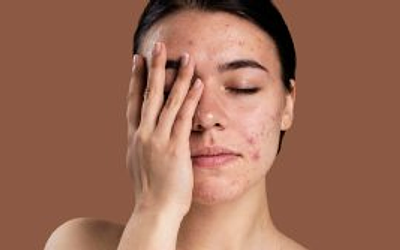 Догляд за проблемною шкірою: як очистити обличчя і покращити стан шкіри
