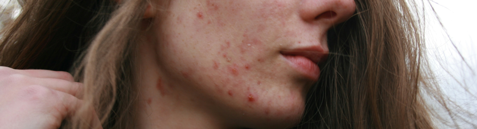 Как эффективно избавиться от прыщей на подбородке: советы от косметологов